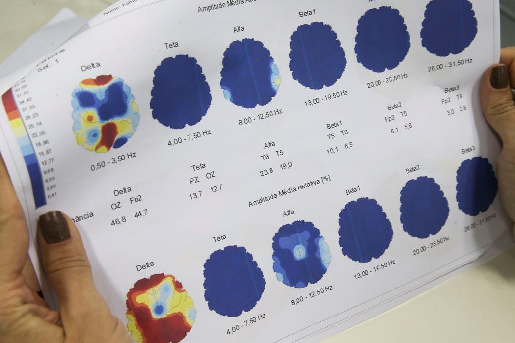 Saúde: Março Roxo quer conscientizar população sobre a epilepsia