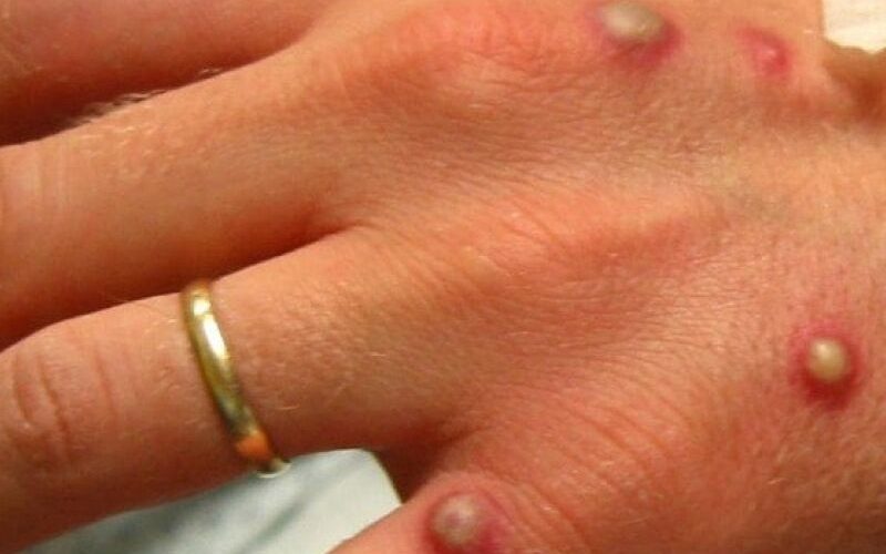 Monkeypox: OMS anuncia resposta unificada contra varíola dos macacos