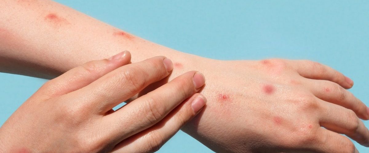 A grande maioria de casos de varíola dos macacos acomete homens que fazem sexo com outros homens.| Foto: IStock