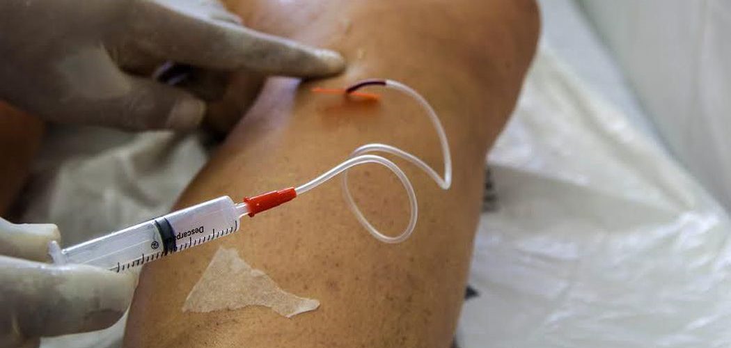 Saúde: A cada dia, 145 mulheres são internadas para tratar varizes