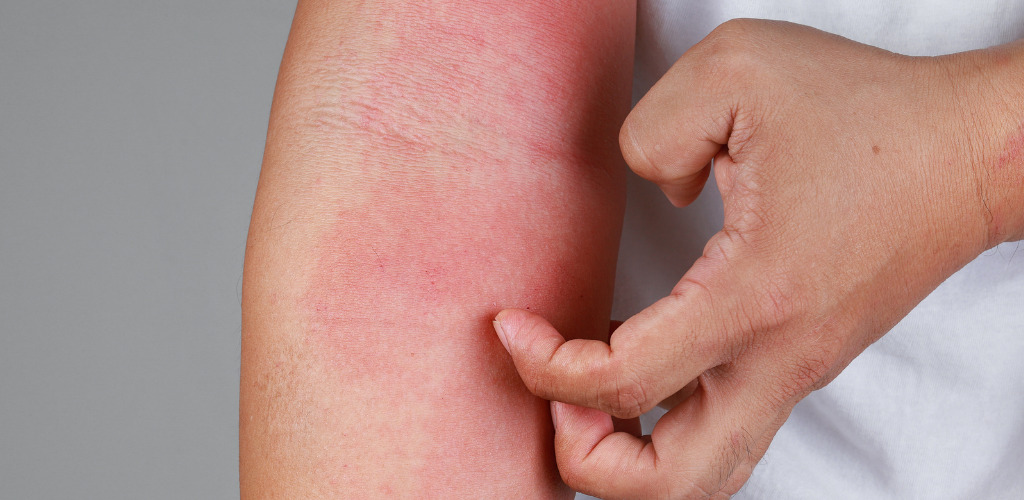 Saúde: Alergia à lactose? Intolerância ao leite?Vamos resolver essa confusão?