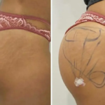 Estética: Sculp Glúteo promete resultado satisfatório com segurança