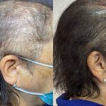 Saúde: Nova linha de produtos de combate a calvice chega a Fortaleza