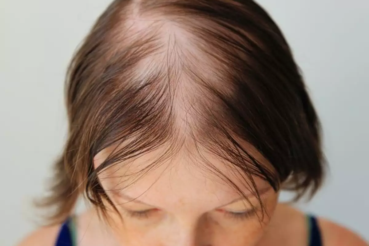 Saúde: Fatores genéticos e hormonais podem causar a alopecia