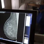 Cerca de 77 mil mulheres aguardam mamografia pelo SUS