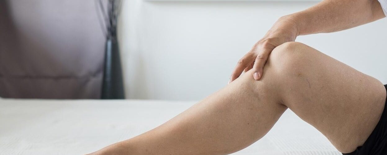 Carnaval e a Saúde das Pernas: Como Evitar Inchaço e Cansaço Durante a Folia