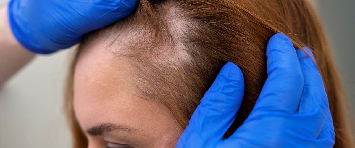Alopecia: queda de cabelo intensa pode ser sinal de alerta para problemas de saúde