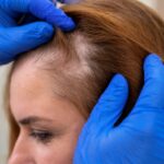 Alopecia: queda de cabelo intensa pode ser sinal de alerta para problemas de saúde