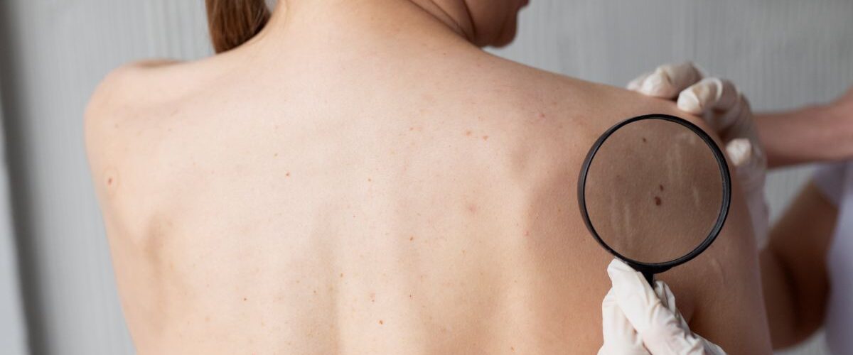Câncer de pele: identificação precoce aumenta chances de cura e reduz riscos