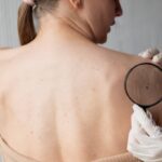 Câncer de pele: identificação precoce aumenta chances de cura e reduz riscos