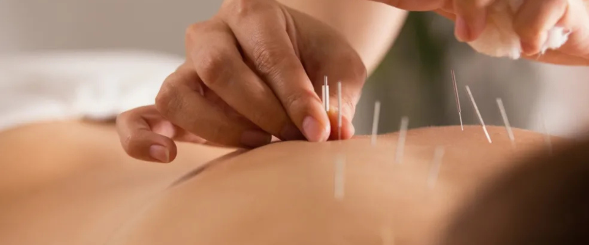 Saúde: Acupuntura alia tradição e ciência
