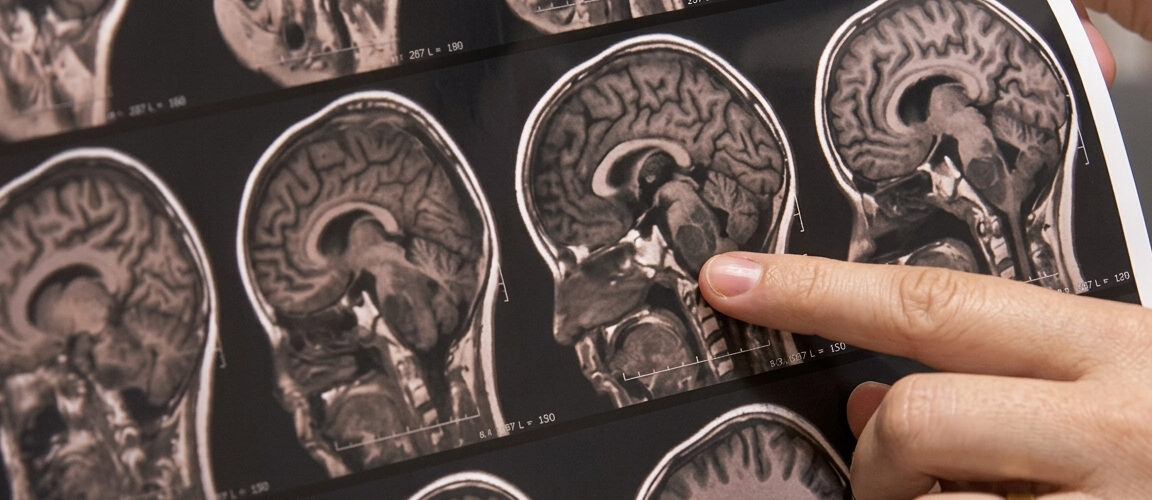 Novo teste identifica tipo de tumor cerebral em horas