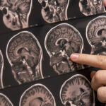 Novo teste identifica tipo de tumor cerebral em horas