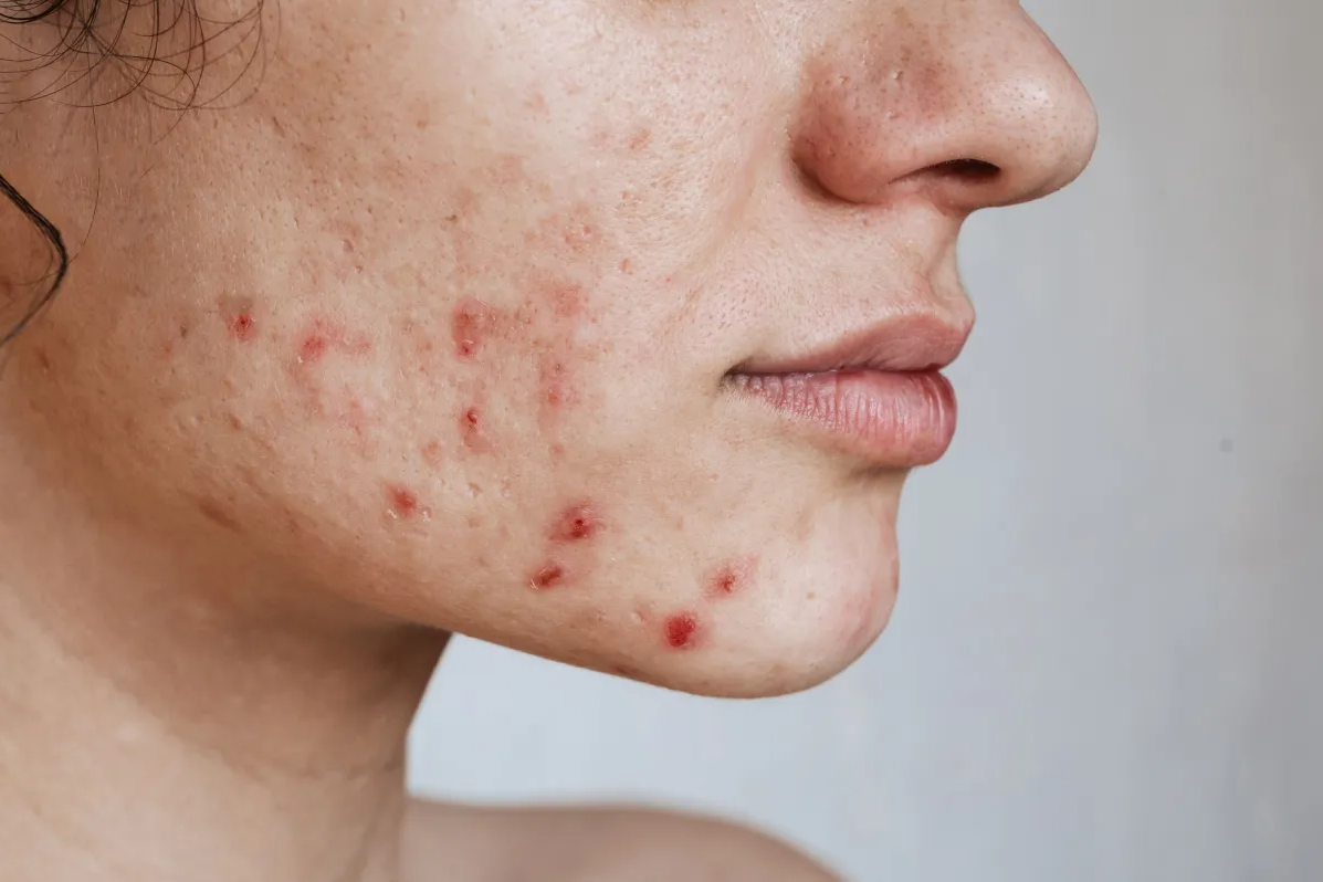 Roacutan quando o medicamento é indicado contra a acne