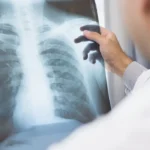 Anvisa aprova novo medicamento contra câncer de pulmão